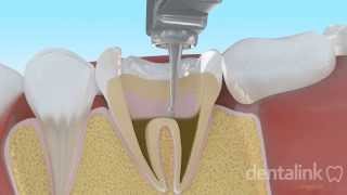 Endodoncia completa PASO A PASO  Video 3D