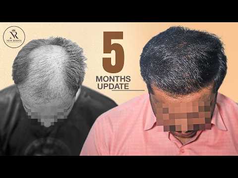 Hair Transplant 5 Months Result 😯 | 5000 Grafts | Hair Transplant in Mumbai | New Roots