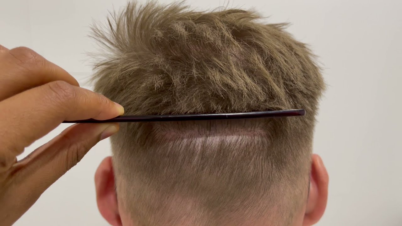 hair transplant scar