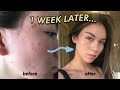 I tried ACNE subliminals for ONE WEEK (it worked!!) 😎