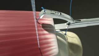 Rotator cuff repair animation with Iconix and ReelX