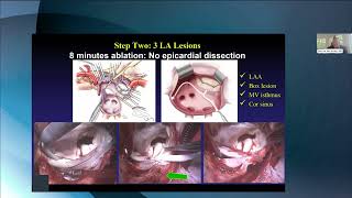 STS Webinar Series: Defining Success in Surgical Treatment of AFib: Updates & New Insights