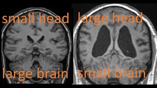 How to adjust brain volumes for age and head size