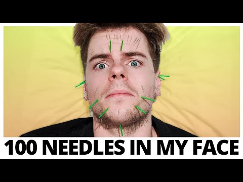 100 NEEDLES in my FACE... Trying Acupuncture for the FIRST TIME