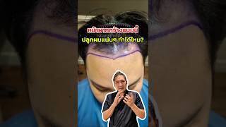 หน้าผากกว้างแบบนี้ ปลูกผมแน่นๆถี่ละเอียดได้ไหม⁉️ #ปลูกผม # #drtophairtransplant