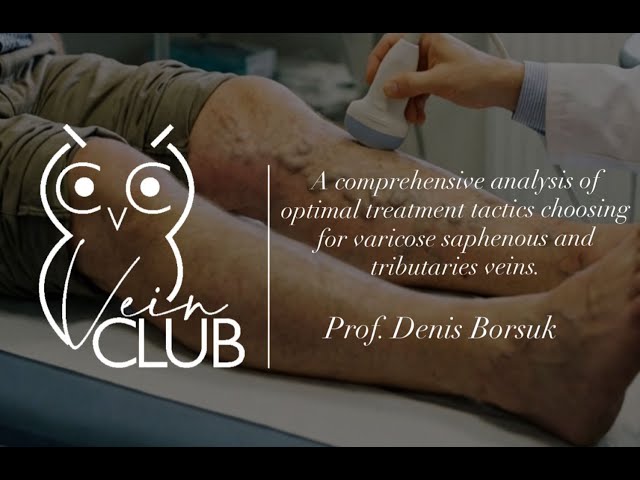 Vein Club: Optimal treatment tactics: Saphenous and Tributaries-Denis Borsuk