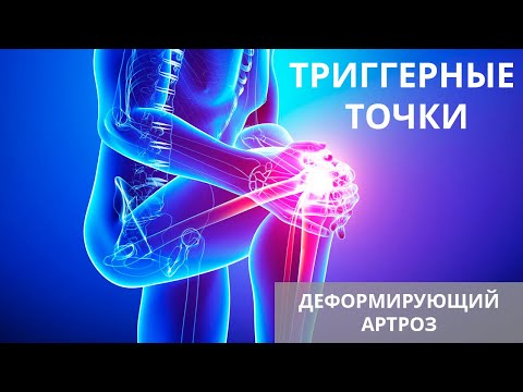 Видео: Триггерные точки и деформирующий артроз