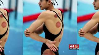 Macon masseuse explains how cupping helps Olympic athletes