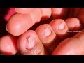 Satisfying pedicure|Ingrown removal(Part27) | Beauty&#39;s Skills