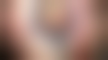 Traumatic Cataract and Aniridia Repair with Artificial Iris