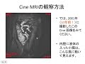 絞扼性イレウスの画像診断 〜 Cine MRIと low b value DWIの意義