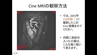 絞扼性イレウスの画像診断 〜 Cine MRIと low b value DWIの意義