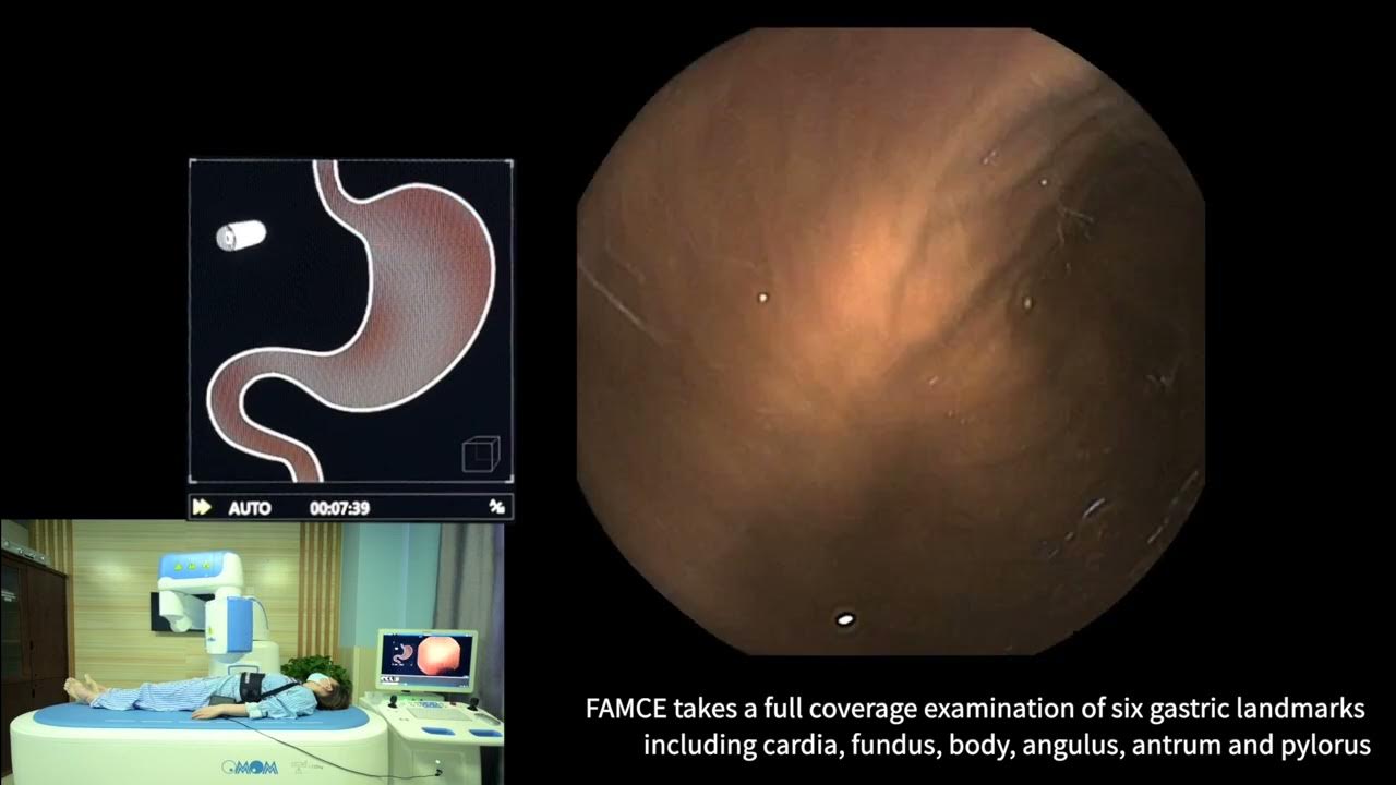 OMOM Robotic Capsule Endoscopy System Procedure YouTube