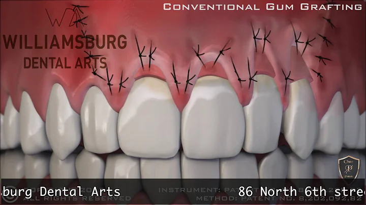 Dr  Sarah Hubert Pin Hole Procedure