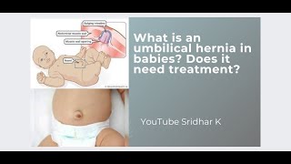 Umbilical Hernia In Babies-What Is It? Does It Need Any Treatment?