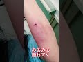 階段から落ちたパート主婦
