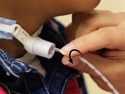 tracheostomy  suction------العنايه التمريضية لانبوب الفتحة العنقية الرغامية