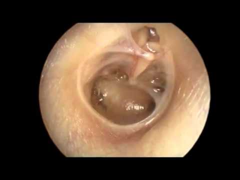 Retracted Ear Drum