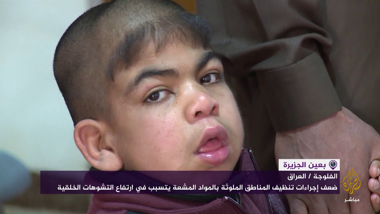 ارتفاع معدلات التشوه الخلقي بين المواليد بالعراق نتيجة مخلفات القصف الأمريكي