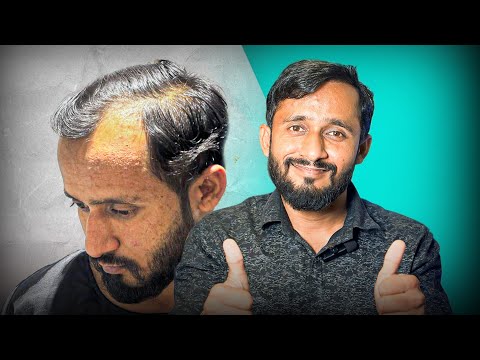 New Roots Offers the BEST Hair Transplant Results 🤩 | Nashik