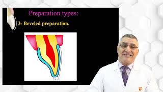 Porcelain laminate veneers Types of Preparation