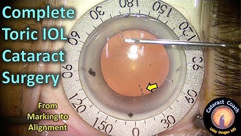 Toric IOL Cataract Surgery Complete from Marking to Alignment