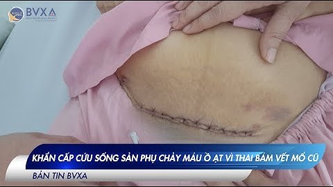 KHẨN CẤP CỨU SỐNG SẢN PHỤ CHẢY MÁU Ồ ẠT VÌ THAI BÁM VẾT MỔ CŨ | BVXA