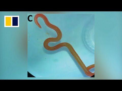 Living worm removed from Australian woman's brain in first known case