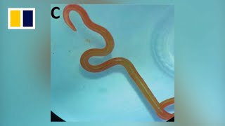 Living worm removed from Australian woman's brain