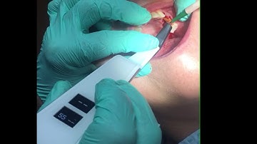 Osstell, Implant stability measuring intrument #zahnarztungarn#zahnpraxisungarn