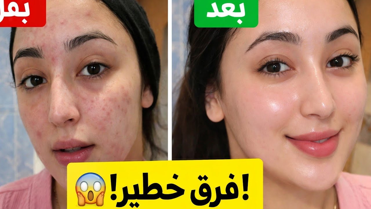 😱 قبل وبعد… تفتيح البشرة وحب الشباب اختفاو بهاد الماسك الطبيعي!