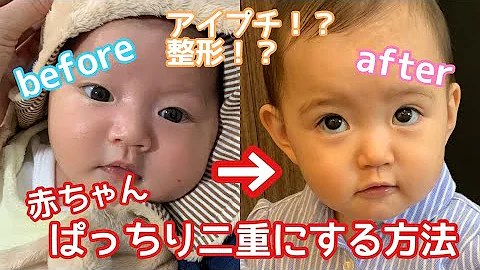 目二重にする