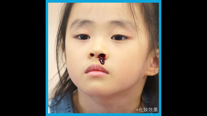 【幼兒急救系列】小孩流鼻血 3個正確處理步驟 - 天天要聞