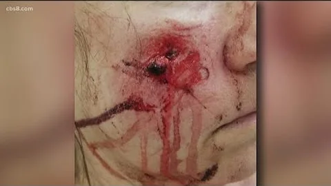 Second woman says she was hit in the face with pro...