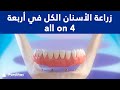 زراعة الأسنان الكل في أربعة   4