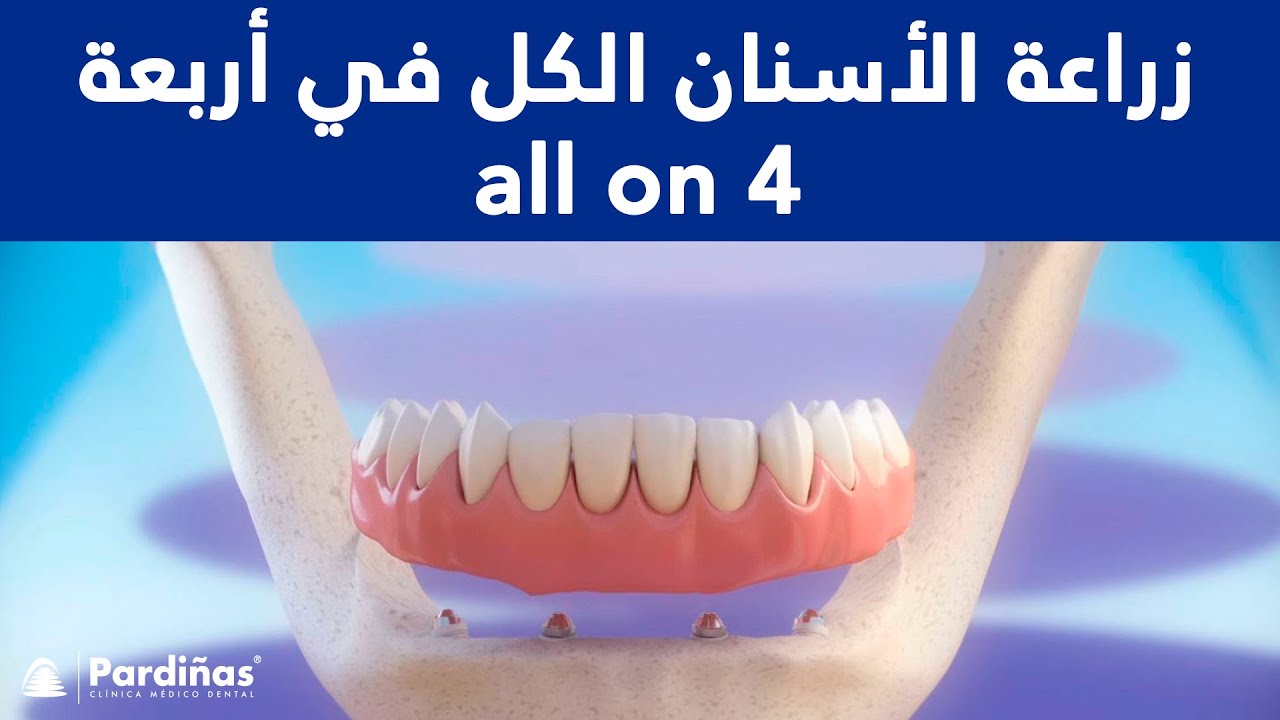 زراعة الأسنان الكل في أربعة all on 4 c youtube زراعة الأسنان الكل في أربعة all on 4 c youtube