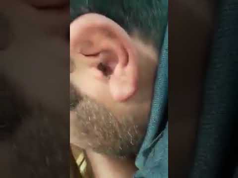 वीडियो: क्या आपके कान में मिलीपेड रेंग सकते हैं?