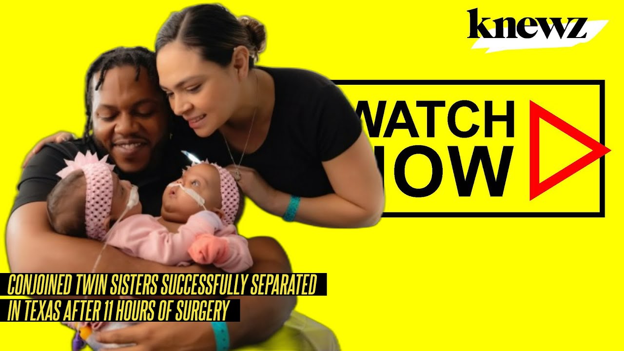 Conjoined Twin Sisters Successfully Separated In Texas After 11 Hours Of Surgery