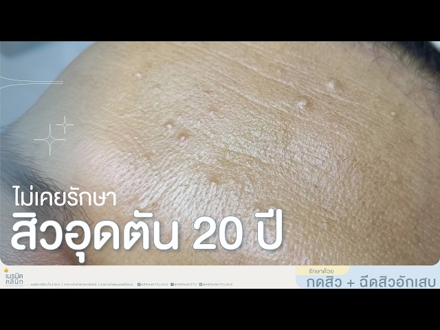 สิวอุดตัน 20 ปี ไม่เคยรักษา EP.349 จากใจคนเป็นสิวมาครึ่งชีวิต... @หมอปุ๊ NeramitClinic