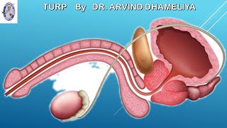 TURP | Prostate surgery | Transurethral Resection of Prostate Animation By Dhameliya Kidney Hospital