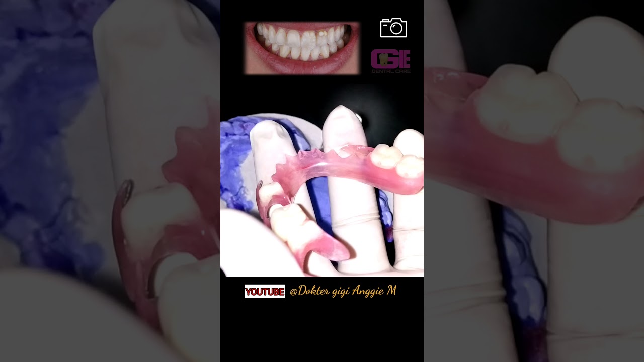 salah satu pilihan gigi tiruan lepasan terbaik 