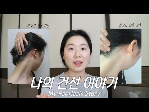 [Sub] 10년간 앓았던 두피 건선이 3주만에 호전된 이유 (feat.청대밤 연고)