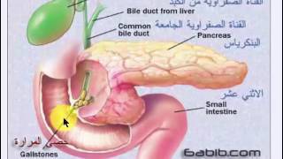 حصى المرارة  موضوع شامل ومبسط