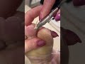Clipping toe skin callus  palmoplantar keratoderma eppk foot callus shave  mar 24 2023