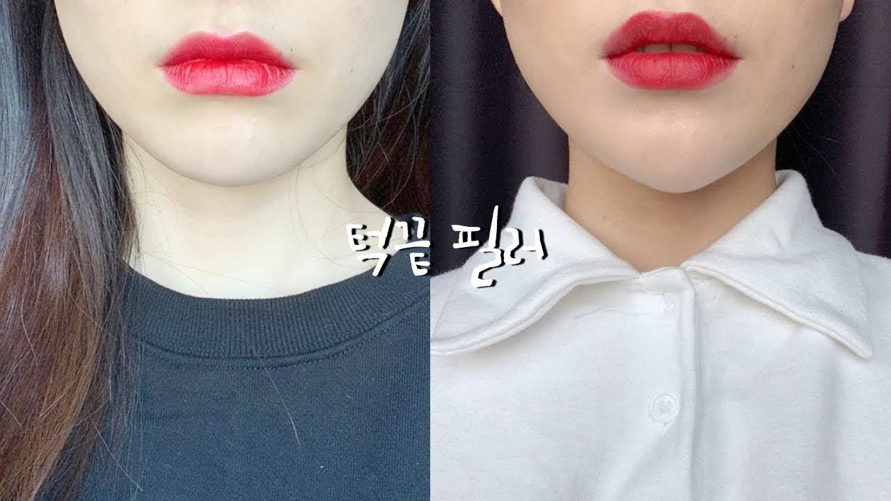 갸름한 턱의 브이라인을 위한 턱끝필러 & 자갈턱 보톡스의 한달 변화과정 +그리고 코끝을 높여주는 하이코 시술 6개월 후 모습 ...