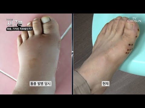 Moxibustion also effective in treating gout! Is it over 90% effective? [Investigative Report Seve...