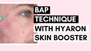 Mesotherapy for Glowing Skin | BAP Technique with Hyaron Skin Booster Ft @Vanidiy