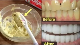 تبييض الأسنان في دقيقتين فقط تبييض الأسنان في المنزل نتيجة فورية لأسنان ناصعة البياض وبدون إصفرار