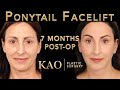 20 YEARS YOUNGER? Ponytail Facelift Before And After & Laser Skin Resurfacing by KAO Plastic Surgery