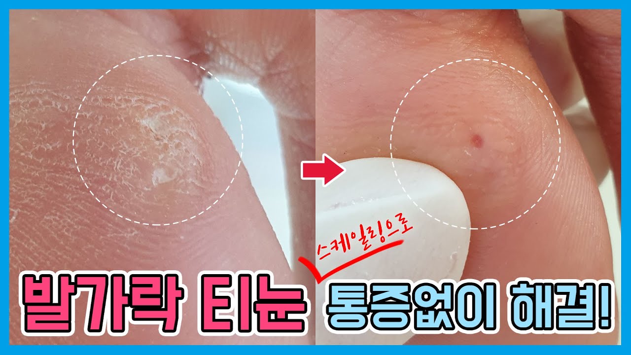 발가락티눈! 스케일링으로 통증없이 제거할수있어요 removing callus / foot scaling - 레푸스 남양주호평점 Refuss - YouTube